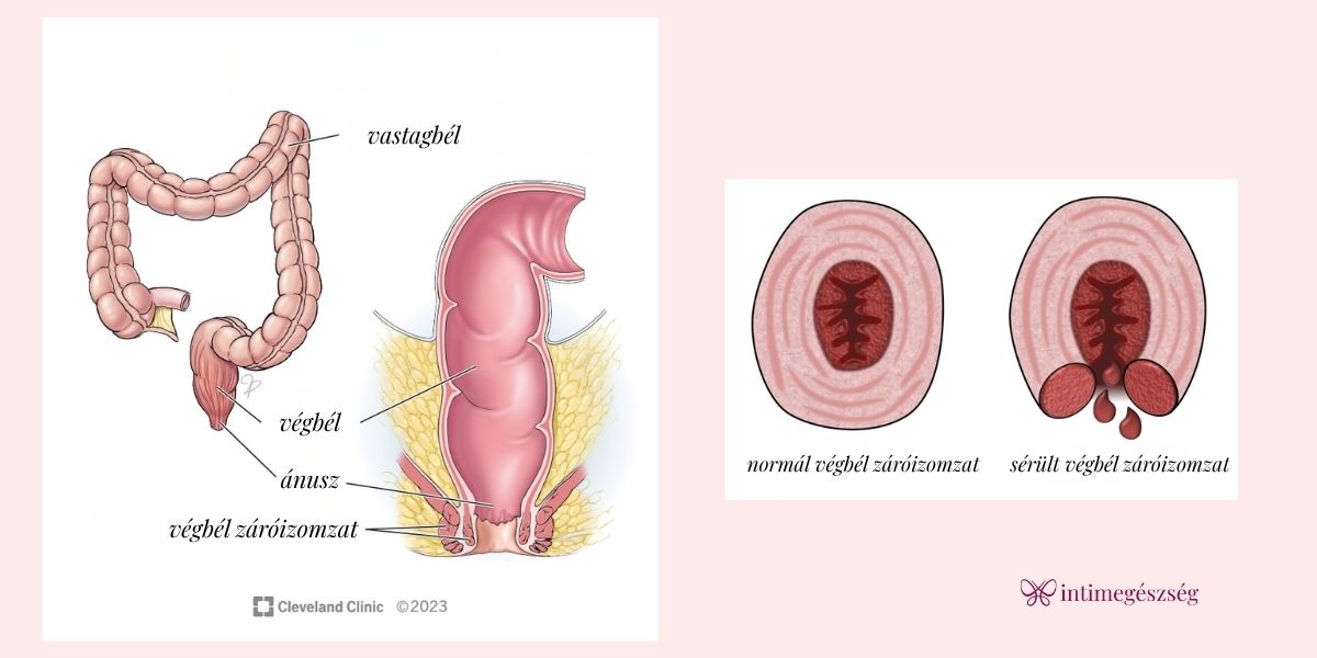 Székletinkontinencia megoldása